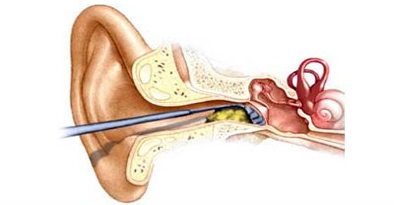 Removing Ear Wax