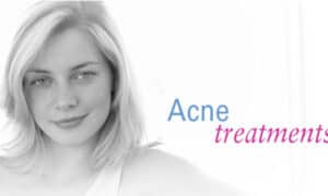 adult acne treatment