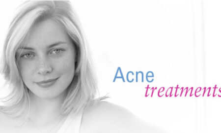 adult acne treatment