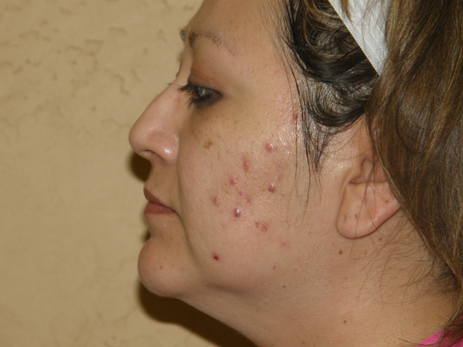 adult acne treatment