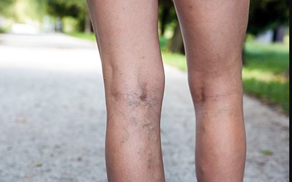 How Can You Remove Visible Veins Safely From Your Legs?