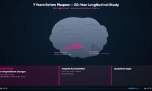 Timeline showing early signs of Alzheimer's disease appearing 7 years before amyloid plaques and 10-15 years before symptoms from September 2026 longitudinal brain imaging study.